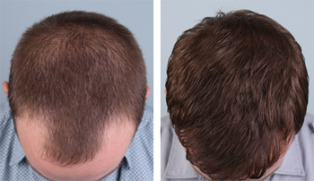 Hair Transplant