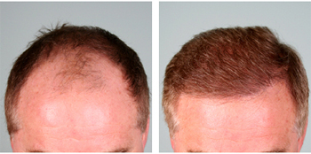 Hair Transplant