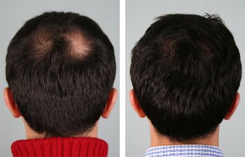 Hair Transplant