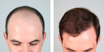 Hair Transplant