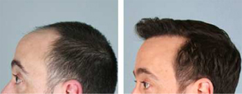 Hair Transplant