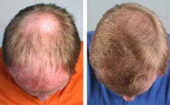 Hair Transplant