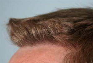 Hair Transplant