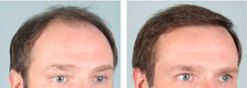 Hair Transplant