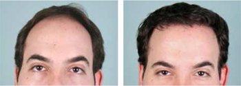 Hair Transplant