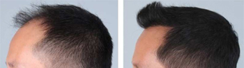 Hair Transplant