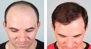 Hair Transplant