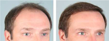 Hair Transplant