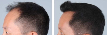 Hair Transplant