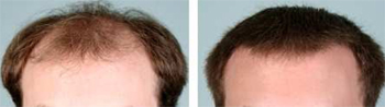 Hair Transplant